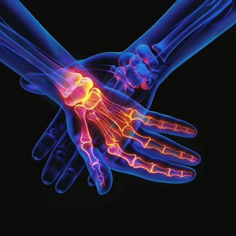 תסמונת התעלה הקרפלית - כאבים בשורש כף היד